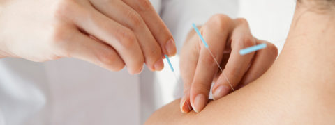 a close up shot of a woman's shoulder. There are a pair of hands inserting acupuncture needles into her shoulder